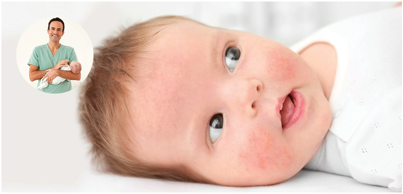 乳児湿疹の治し方
