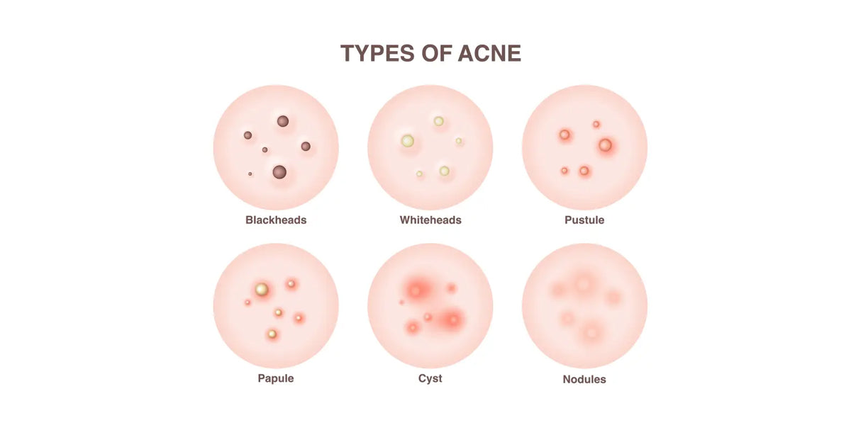skincare routine for different types of acne 