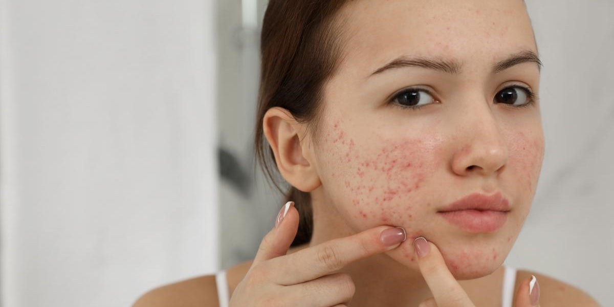 how to treat acne effectively