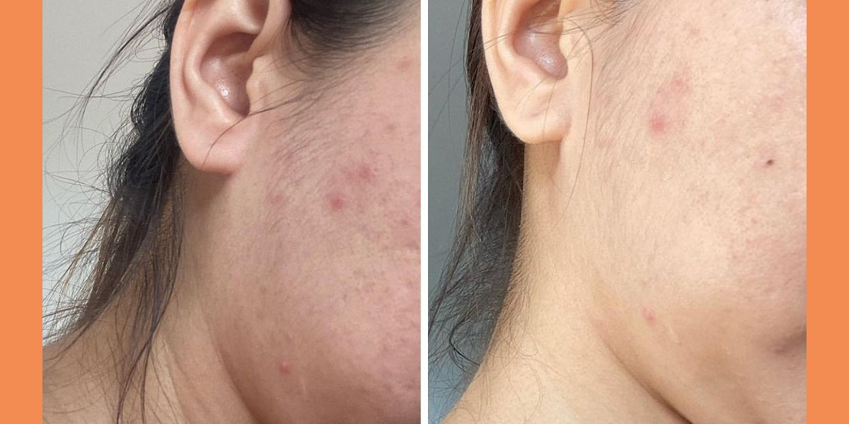 Skin rejuvenation for acne-prone skin