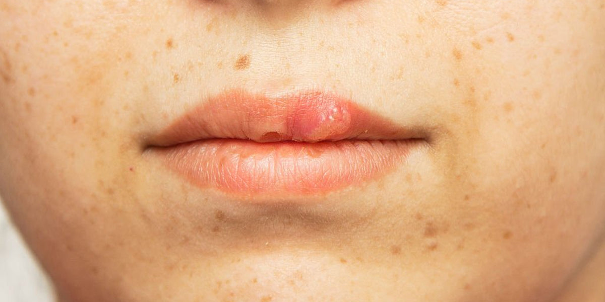 Who is more prone to develop Pigmentation Around Mouth