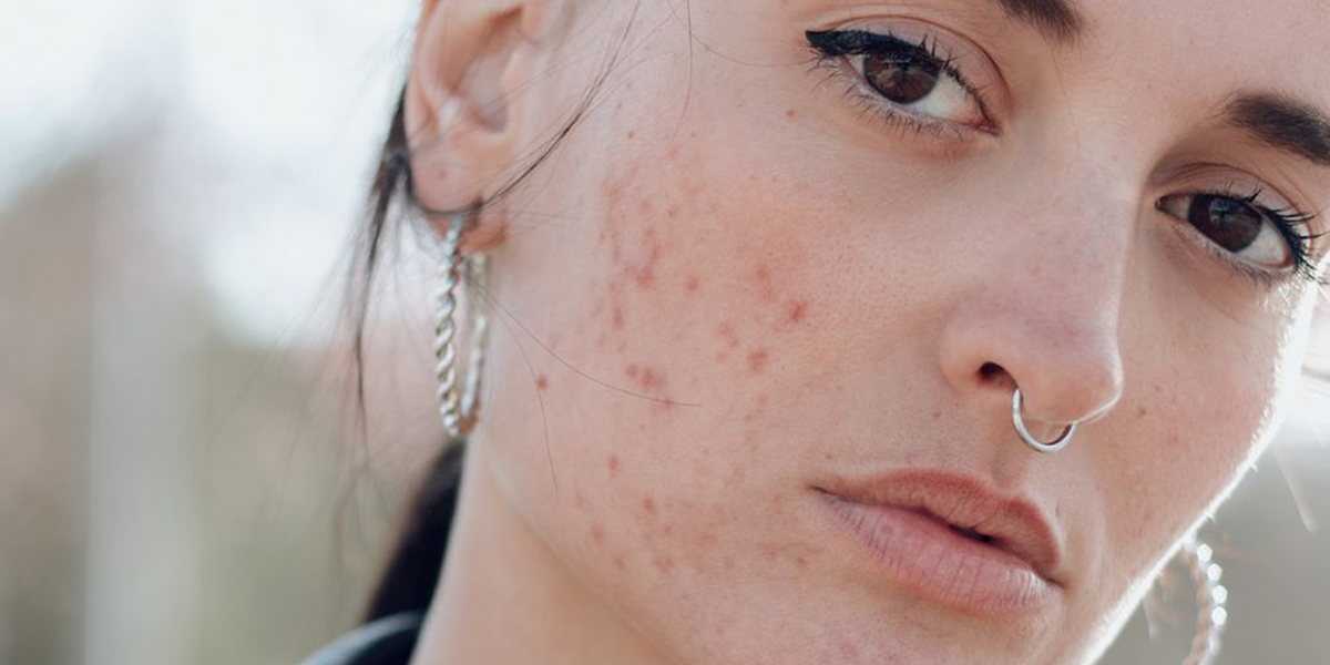 how to get rid of acne scars fast - types of scars