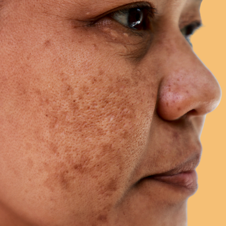 Melasma in het gezicht