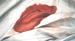 Blood stained white sheet