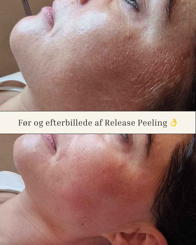 Release Peeling som Hårfjerning