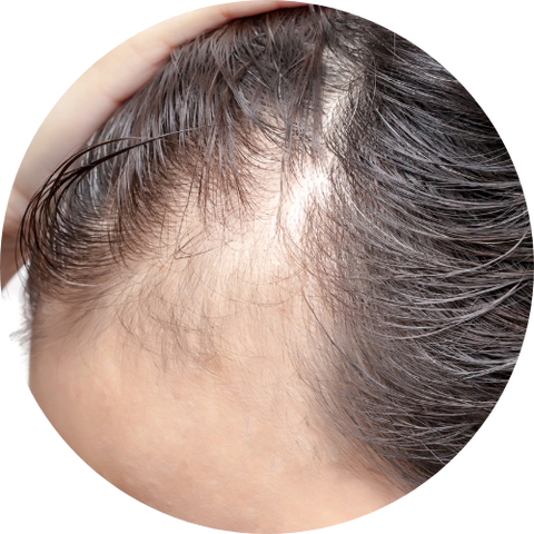 5 problèmes de santé qui occasionnent la chute des cheveux – Krynéo
