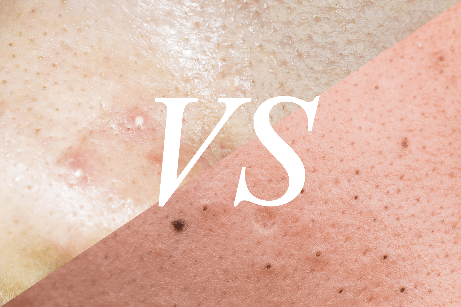 Comparing Whiteheads vs Blackheads Dr. Dennis Gross