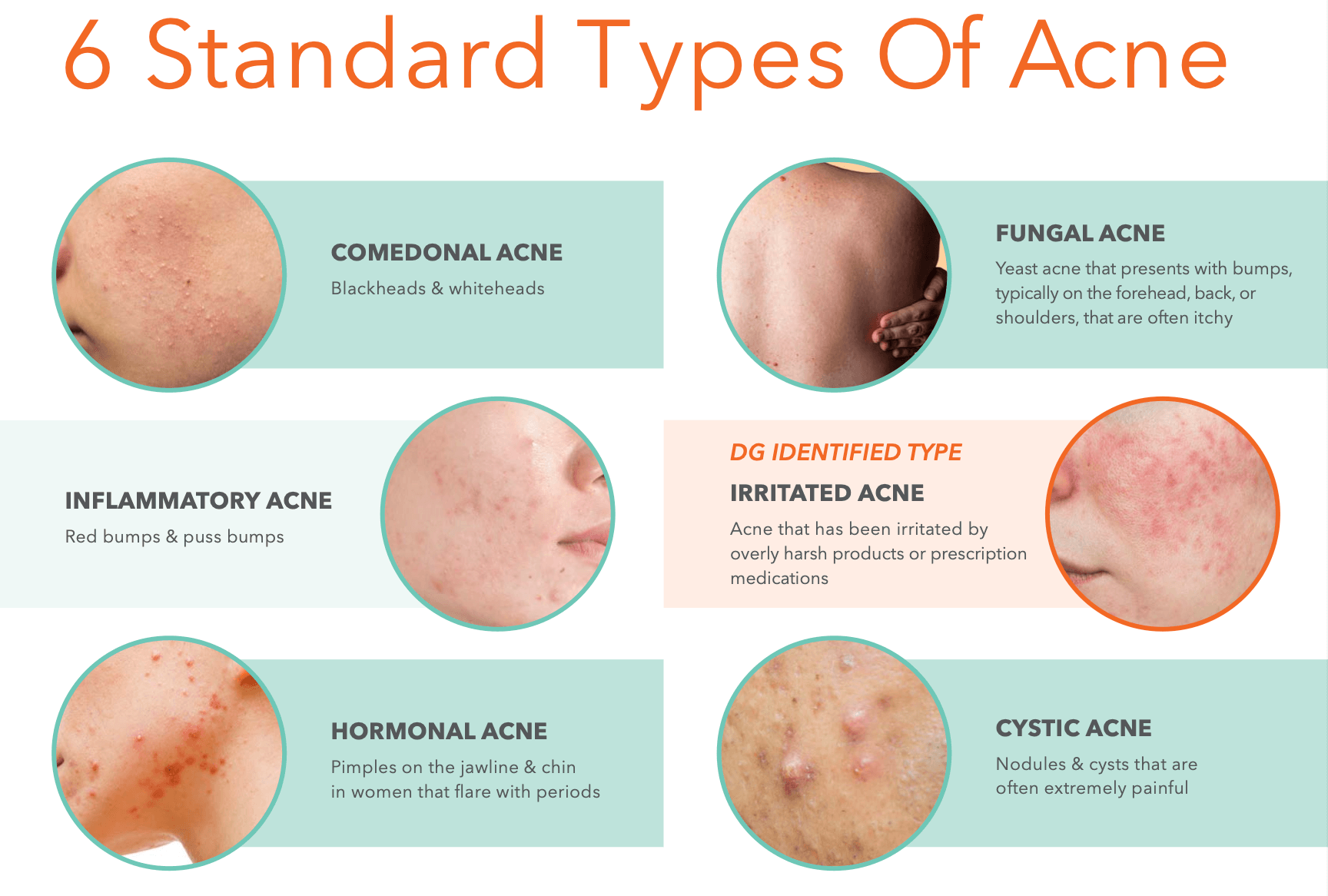 6 types of acne by Dr. Dennis Gross