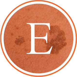 Melanoma E