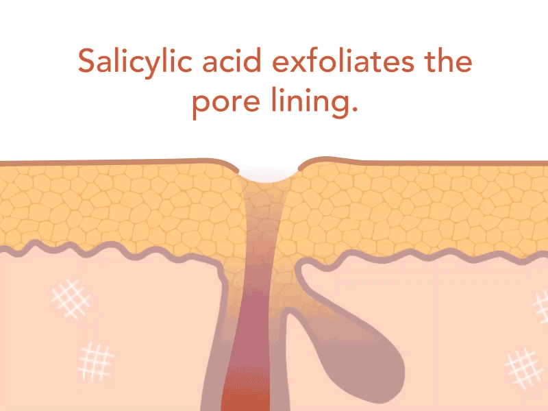 Salicylic acid exfoliates the pore lining