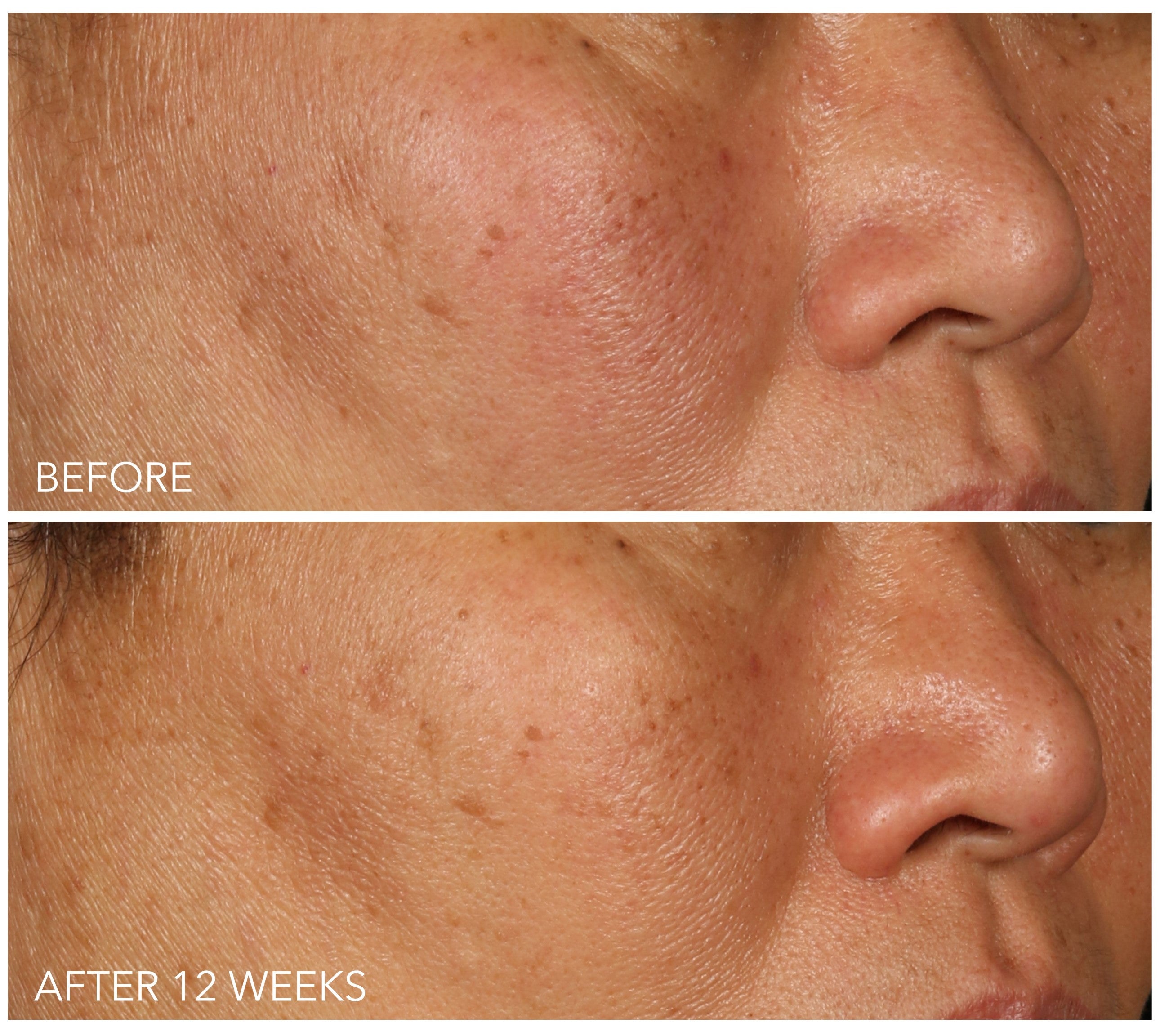 Before and after 12 weeks using Vitamin C Lactic - 15% Vitamin C Firm & Bright Serum