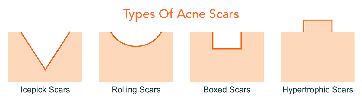 Types of acne scars