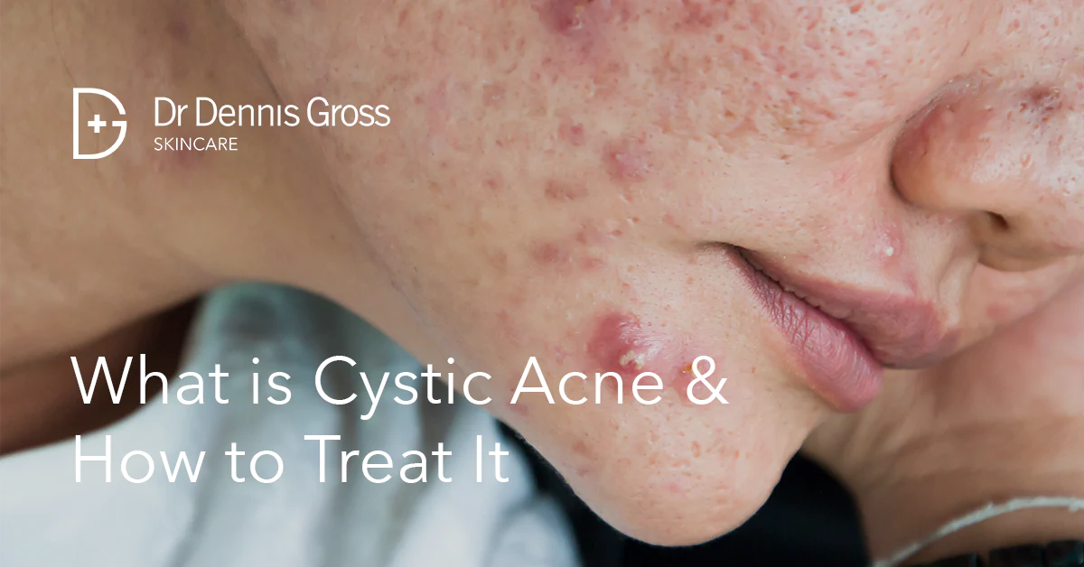 How to Treat Cystic Acne