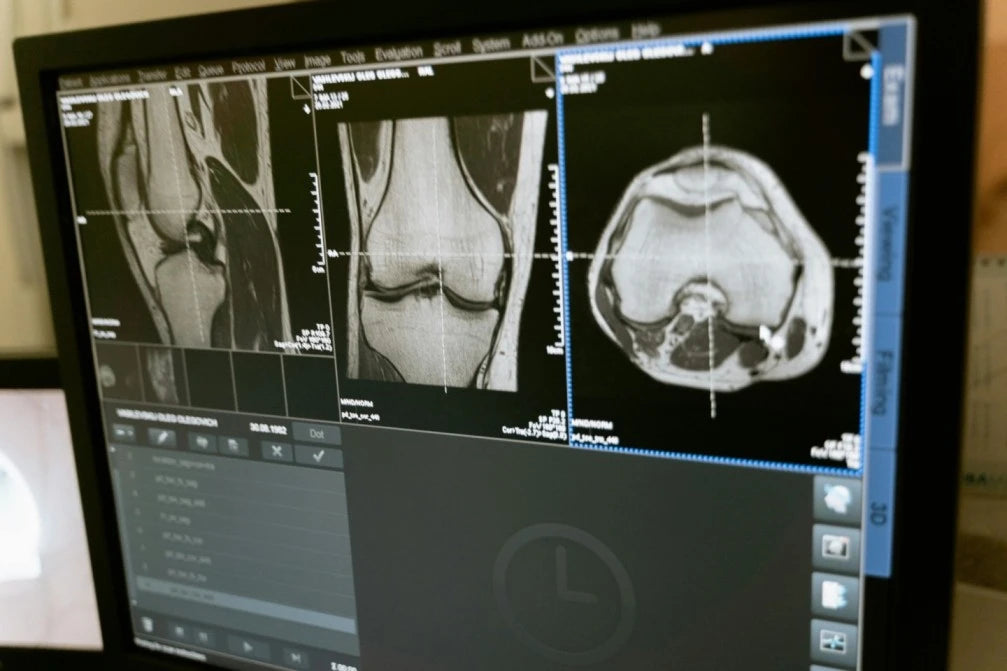 X-ray Scans to understand bone health