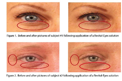 RevitalEyes - Before & After