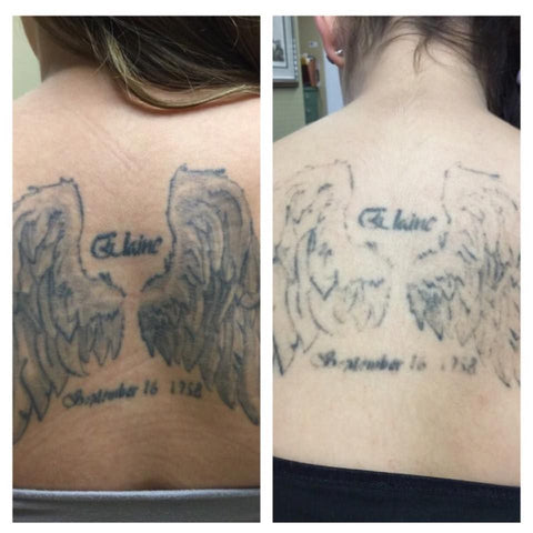 Tattoo Removal Seattle  Tattoo Removal Bellevue