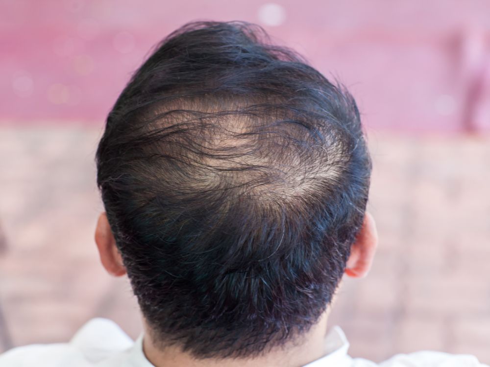 أسباب الشعر الخفيف عند الرجال