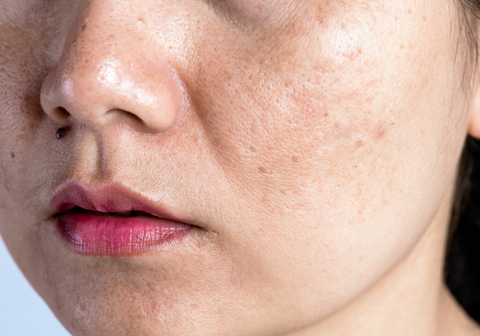 hyperpigmentation close up of woman's face
