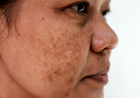 Woman With hyperpigmentation Dark patches On Their Skin