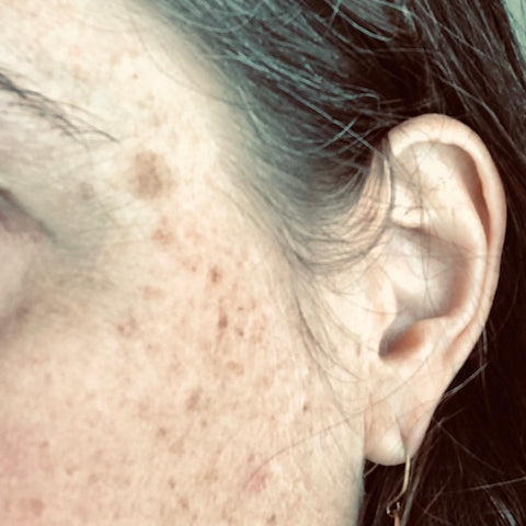 facial melasma hyperpigmentation