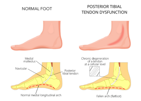 Medical Illustration of Posterior Tibial Tendon Dysfunction and Flat Foot