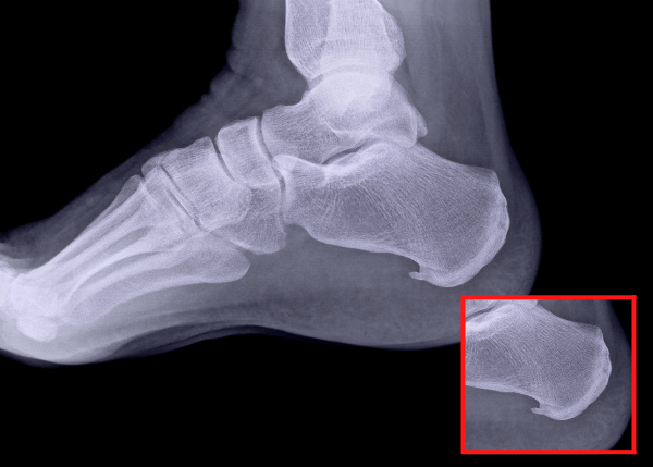Plantar Heel Pain Workup: Laboratory Studies, Imaging Studies