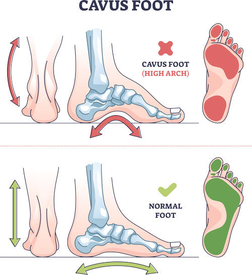 Causes of Supination and Treatment - High Arched Foot