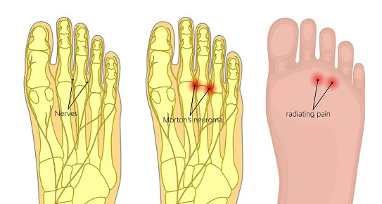 Illustration of a foot with and without Morton’s neuroma