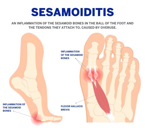 illustration of a big toe and tendon with sesamoiditis