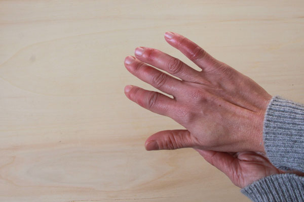 woman’s hands with chilblains on fingers