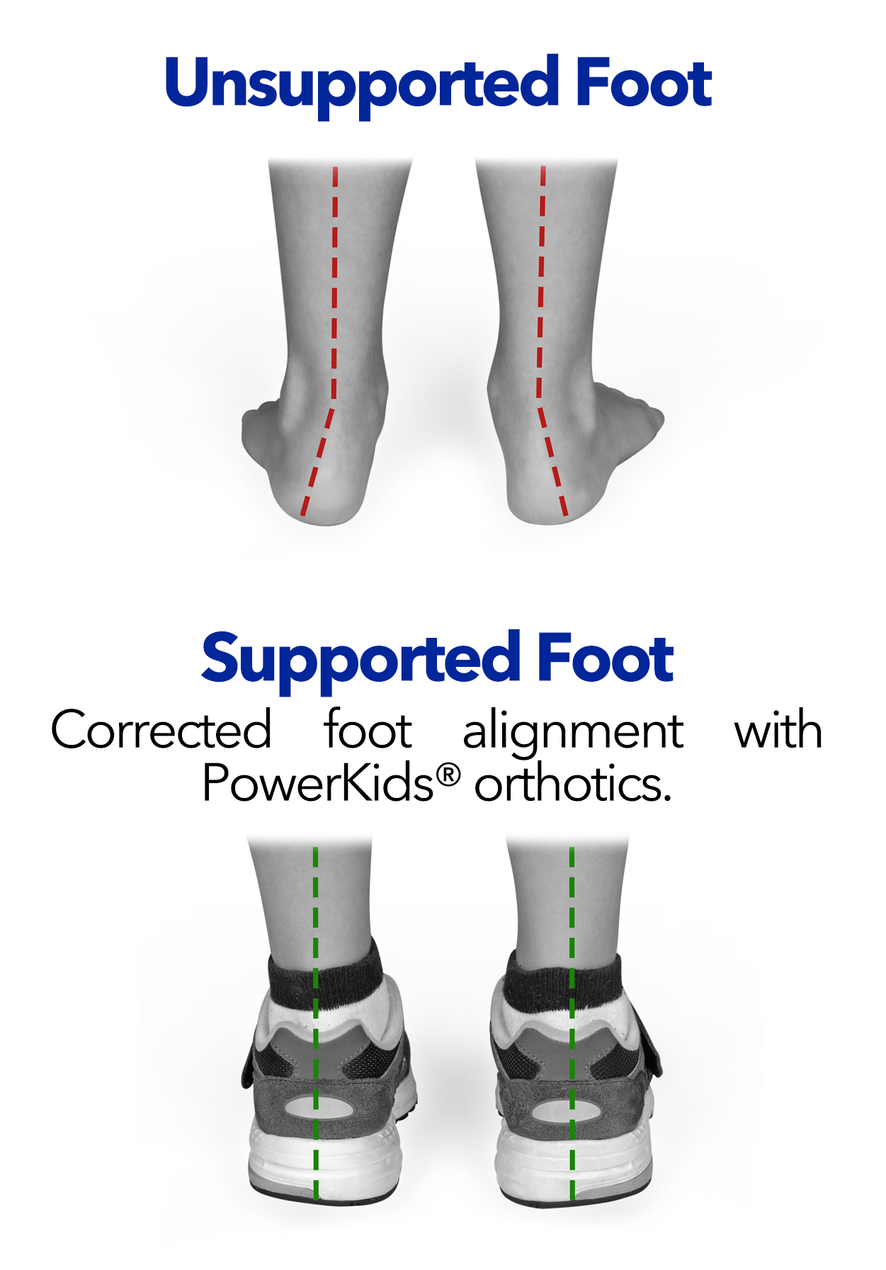child's unsupported foot, child's foot supported with powerstep powerkids 3/4