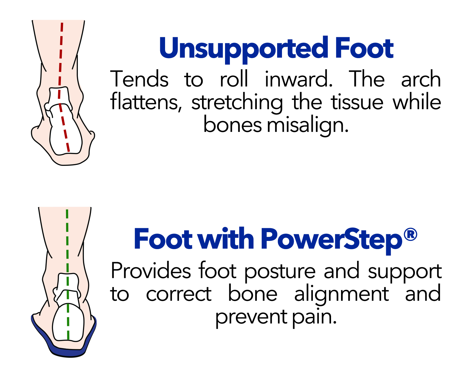 unsupported foot without powerstep and supported foot with powerstep orthotics