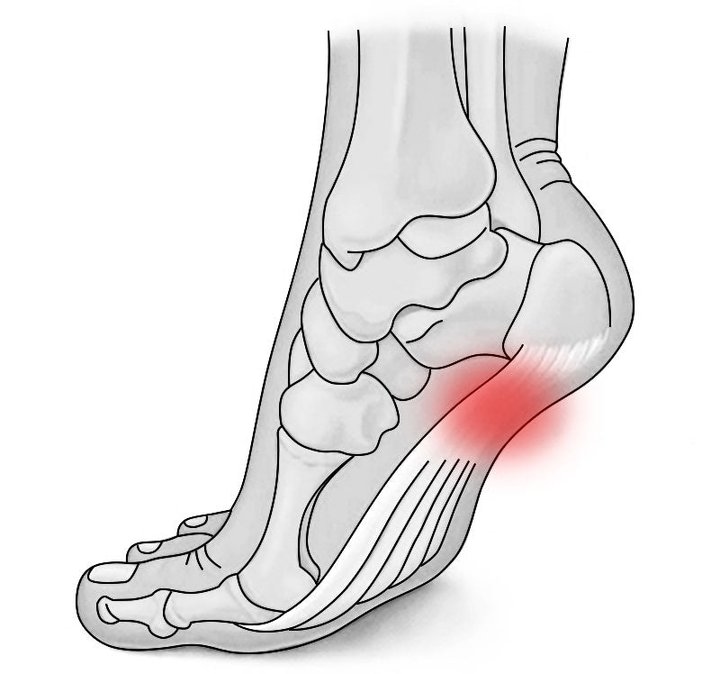 drawing of plantar fasciitis pain location in foot