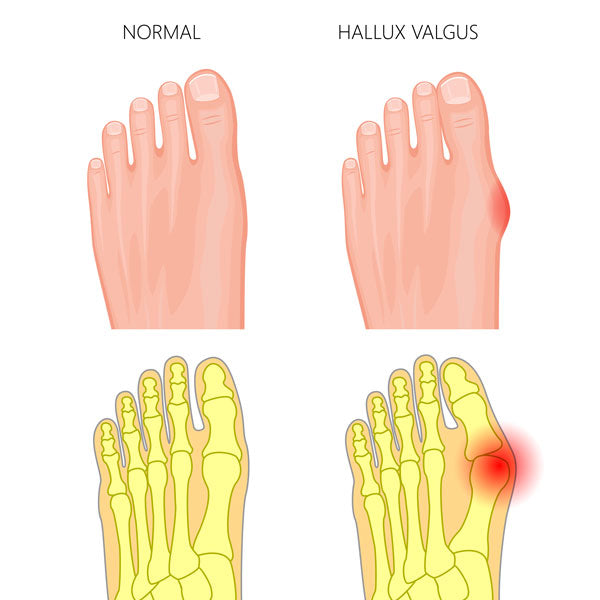Graphic comparing a normal foot and a foot with a bunion