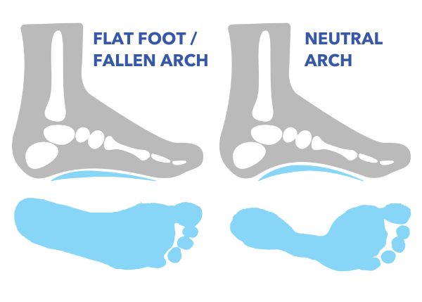 Adult acquired flatfoot deformity – fallen arches and flat feet