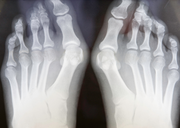 X-Ray image of two feet with bunions