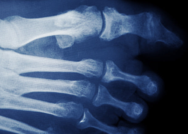 X-ray of hammer toe