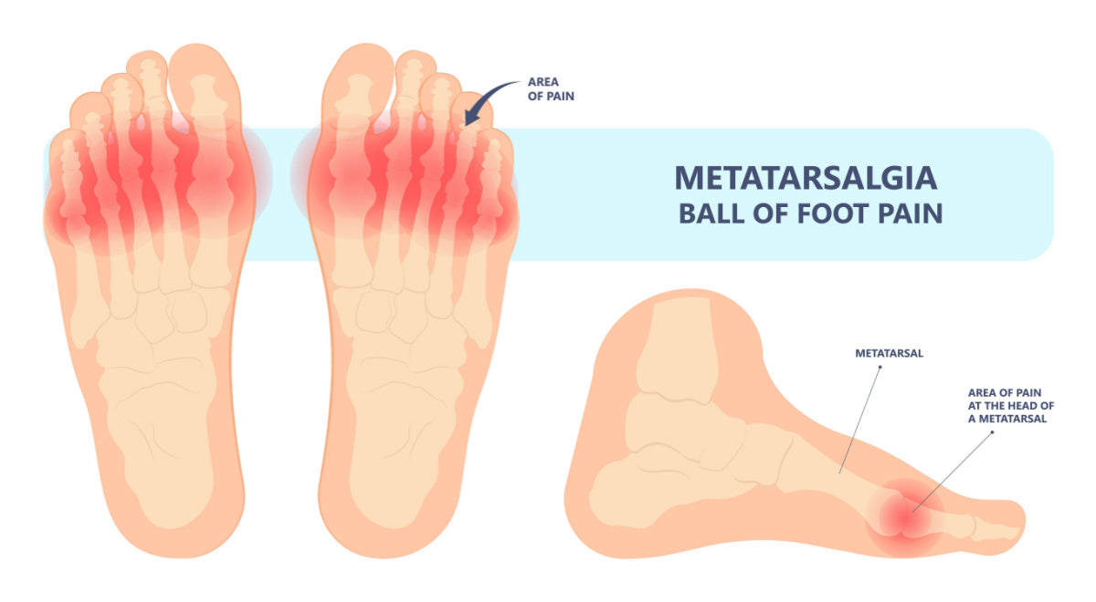 Detailed medical image of the location of metatarsal pain in the foot.