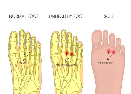 Graphic comparing a normal foot and a foot with Morton’s Neuroma