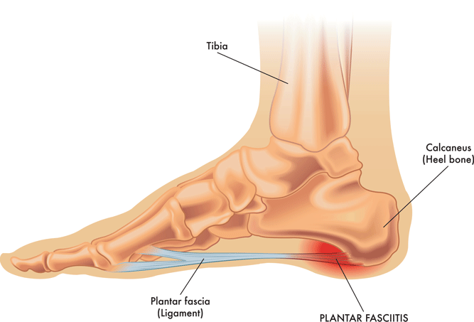 Graphic of a foot with plantar fasciitis