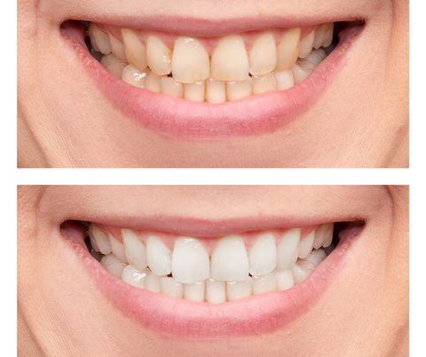 is teeth whitening permanent