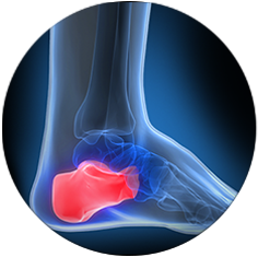 heel pain