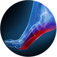 plantar fasciitis