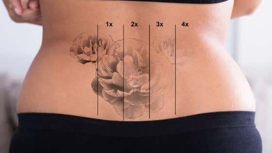 Giải đáp câu hỏi How much is tattoo removal và nên không nên từ bỏ khẩu hiệu xăm hình 'vĩnh viễn'