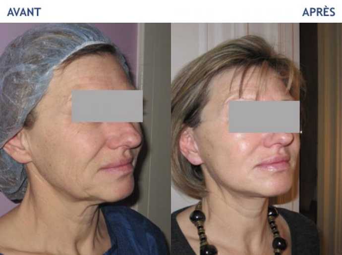 facelift1