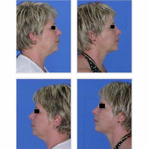 facial liposuction before after 2 jpg