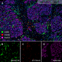 Human pancreatic carcinoma tissue CD68 (EM1901-95, green), CD163 (ET1704-43, red) , PanCK (HA601094, violet)