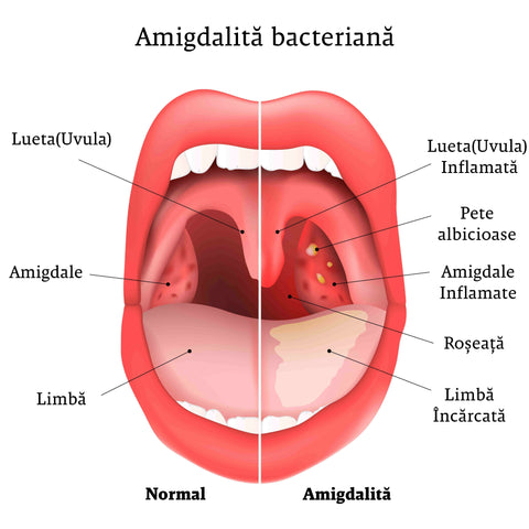 amigdalita bacteriana