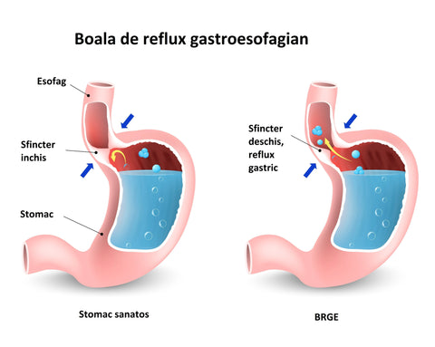 reflux gastroesofagian
