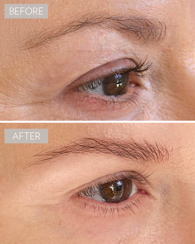 professional brow lift